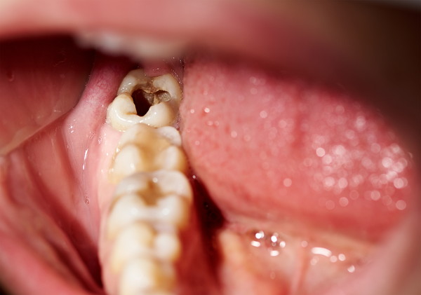 奥歯の虫歯